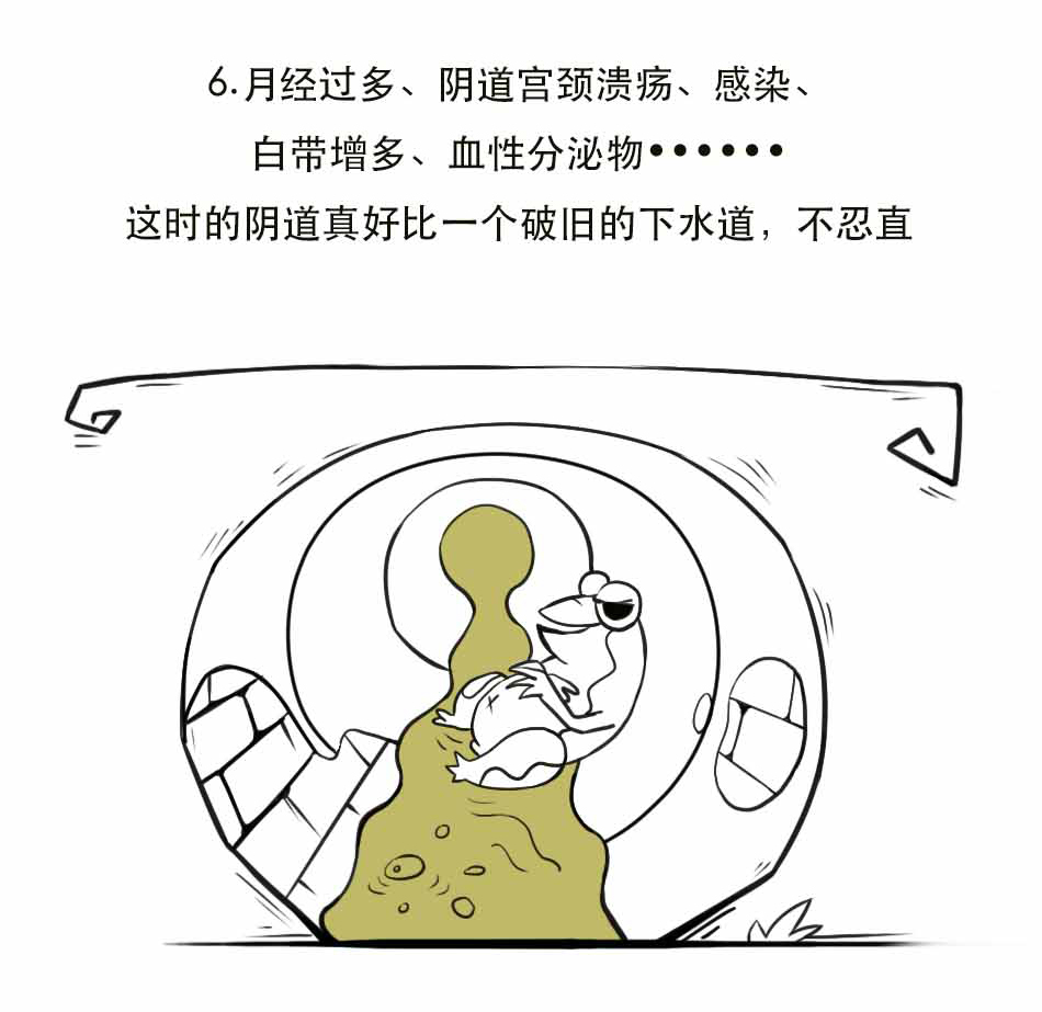 子宫脱垂听起来好吓人？_12.jpg